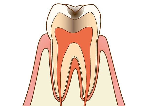 エナメル質の下の象牙質も虫歯に侵された状態