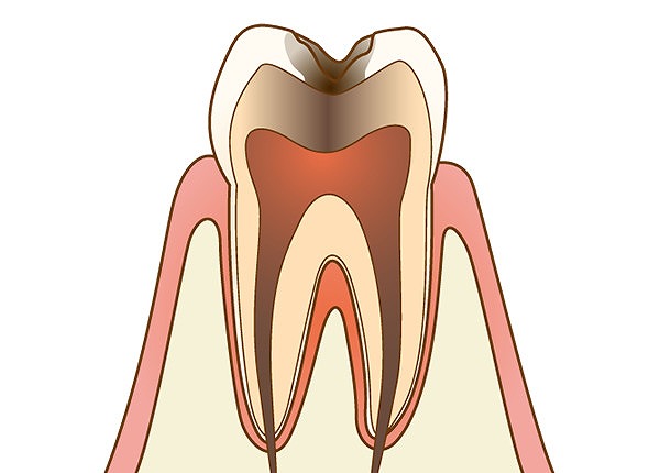 歯髄まで虫歯に侵された状態