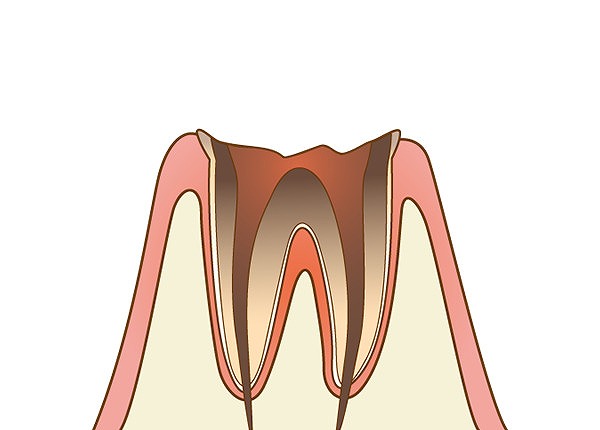 歯冠部がほとんどなく、歯槽骨まで虫歯が達している状態