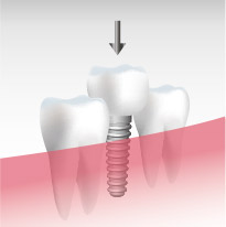 インプラント
